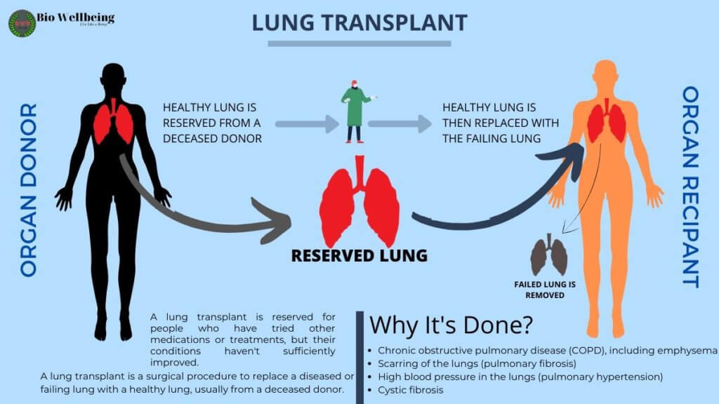 cf-lung-transplant