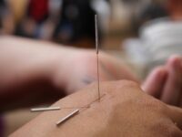 5 Reasons Acupuncture Help Treat Lower Back Pain