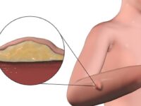 Why Is Lipoma and Skin Cyst Removal Surgery in Singapore So Popular?